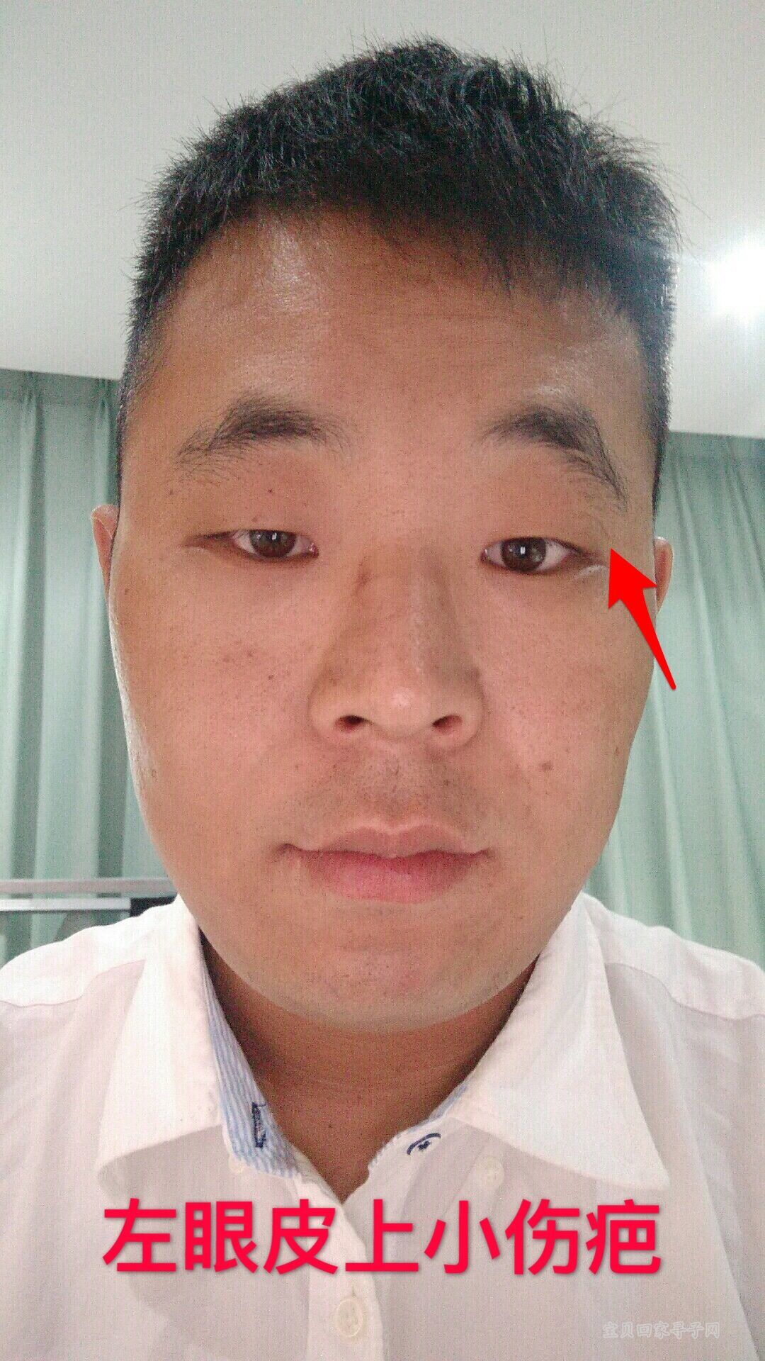 左眼皮上的小伤疤.jpg